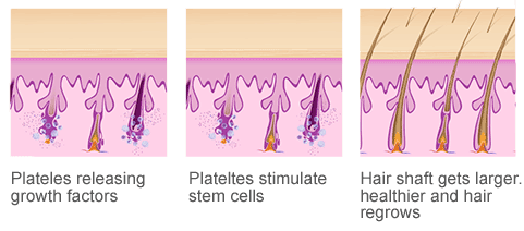 How PRP Works On Hair Loss